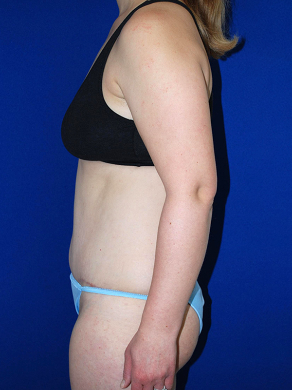 Extended Abdominoplasty Before and After | Plastic Surgery Institute of Washington