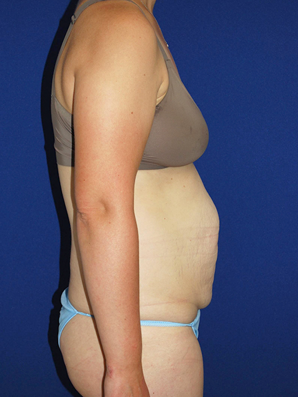 Extended Abdominoplasty Before and After | Plastic Surgery Institute of Washington