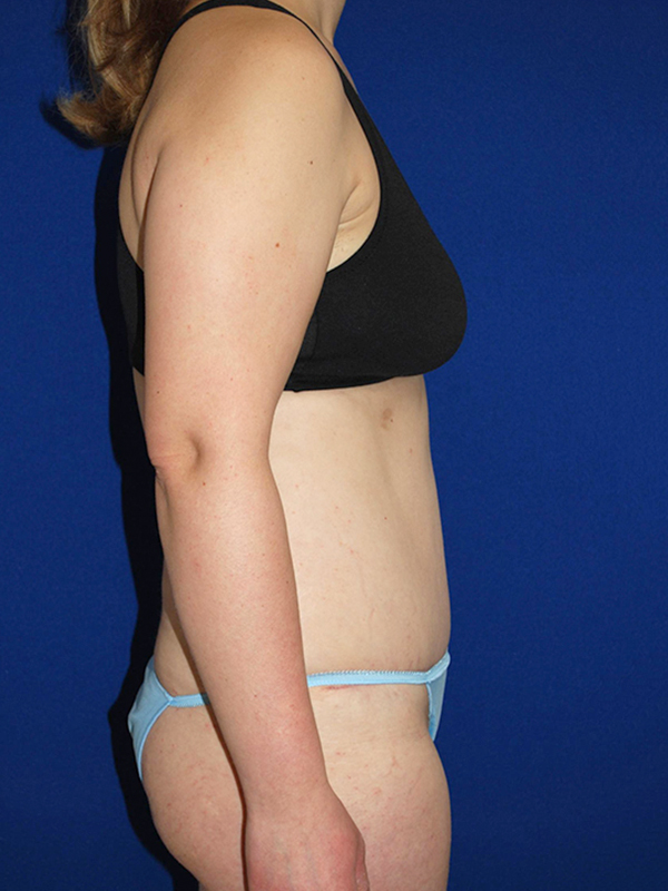 Extended Abdominoplasty Before and After | Plastic Surgery Institute of Washington