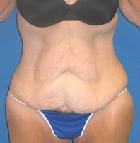 Extended Abdominoplasty Before and After | Plastic Surgery Institute of Washington