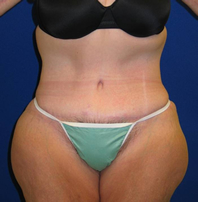 Extended Abdominoplasty Before and After | Plastic Surgery Institute of Washington