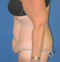 Extended Abdominoplasty Before and After | Plastic Surgery Institute of Washington