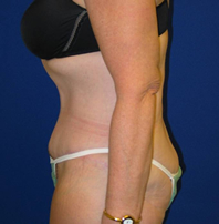 Extended Abdominoplasty Before and After | Plastic Surgery Institute of Washington