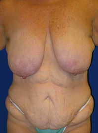 Extended Abdominoplasty Before and After | Plastic Surgery Institute of Washington