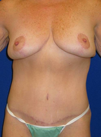 Extended Abdominoplasty Before and After | Plastic Surgery Institute of Washington