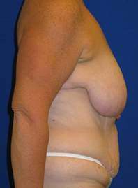 Extended Abdominoplasty Before and After | Plastic Surgery Institute of Washington