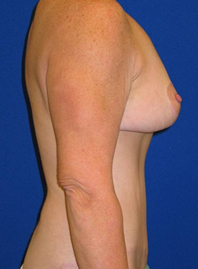 Extended Abdominoplasty Before and After | Plastic Surgery Institute of Washington