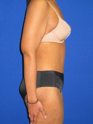 Extended Abdominoplasty Before and After | Plastic Surgery Institute of Washington