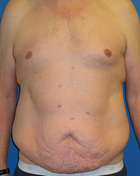 Extended Abdominoplasty Before and After | Plastic Surgery Institute of Washington