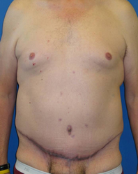 Extended Abdominoplasty Before and After | Plastic Surgery Institute of Washington