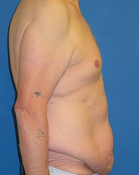 Extended Abdominoplasty Before and After | Plastic Surgery Institute of Washington