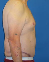 Extended Abdominoplasty Before and After | Plastic Surgery Institute of Washington