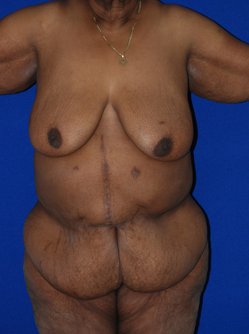 Extended Abdominoplasty Before and After | Plastic Surgery Institute of Washington