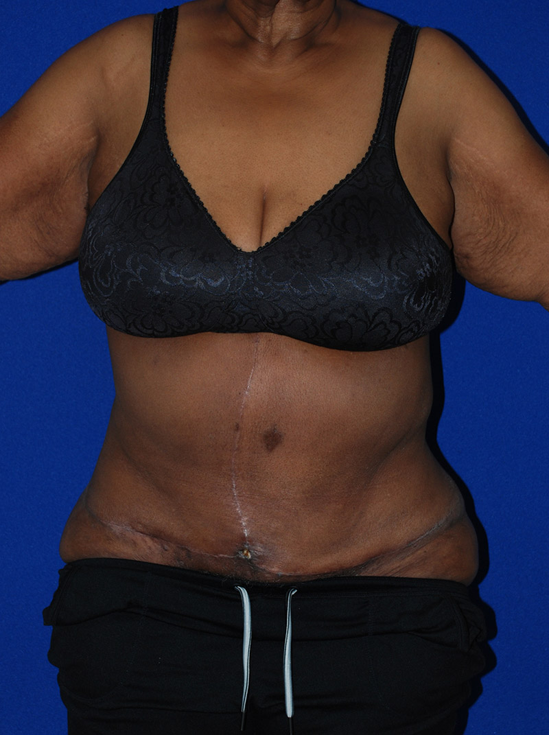Extended Abdominoplasty Before and After | Plastic Surgery Institute of Washington