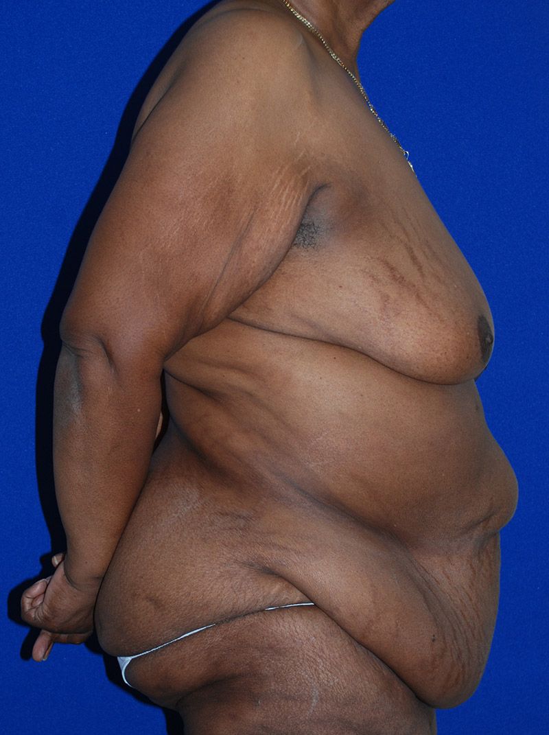 Extended Abdominoplasty Before and After | Plastic Surgery Institute of Washington