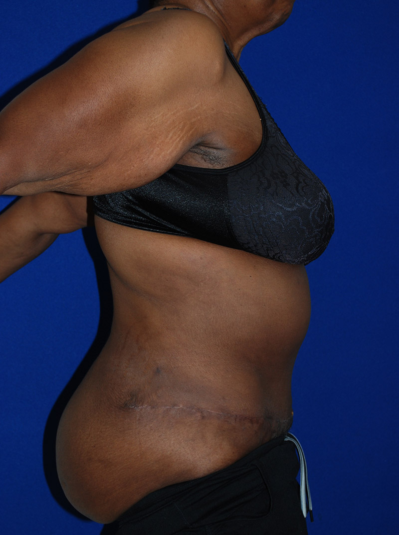 Extended Abdominoplasty Before and After | Plastic Surgery Institute of Washington