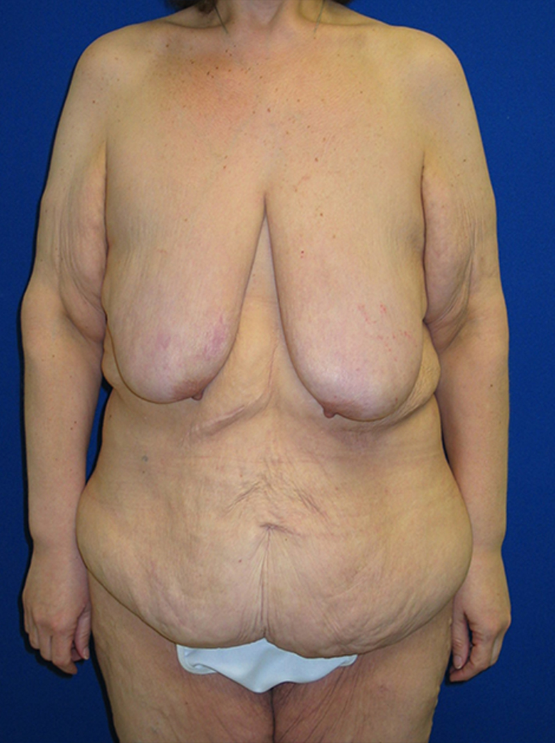 Extended Abdominoplasty Before and After | Plastic Surgery Institute of Washington
