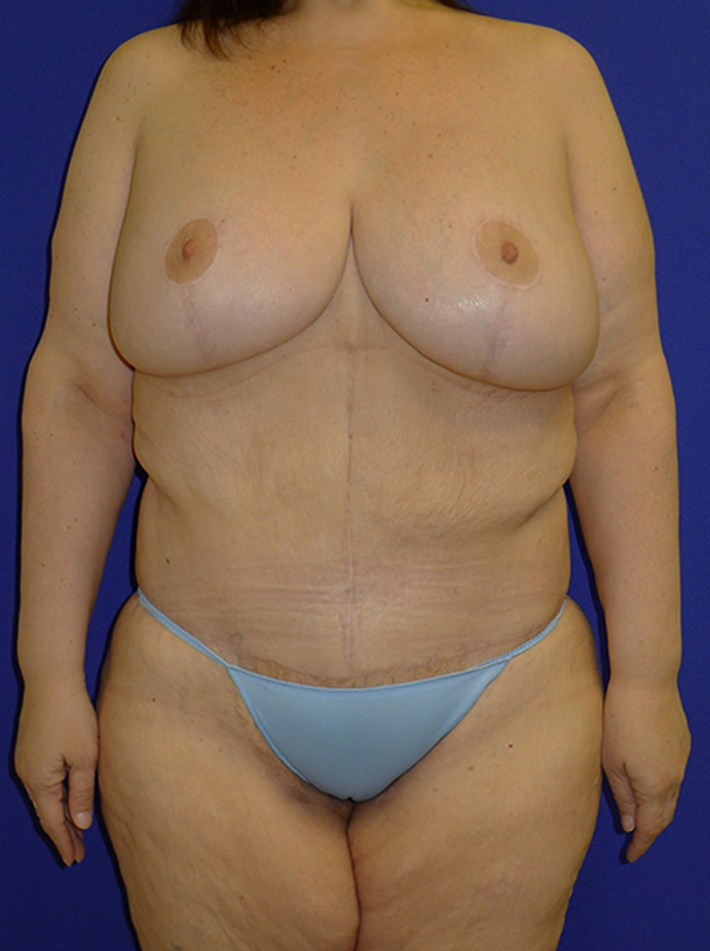 Extended Abdominoplasty Before and After | Plastic Surgery Institute of Washington