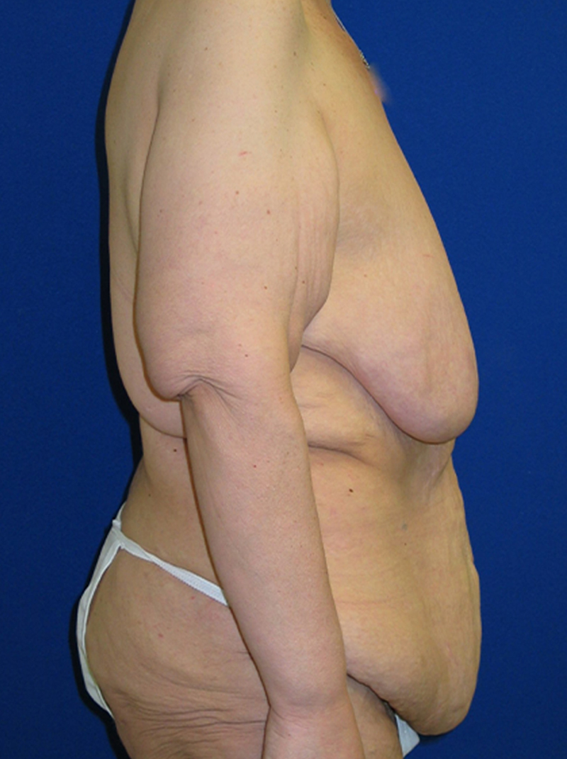 Extended Abdominoplasty Before and After | Plastic Surgery Institute of Washington