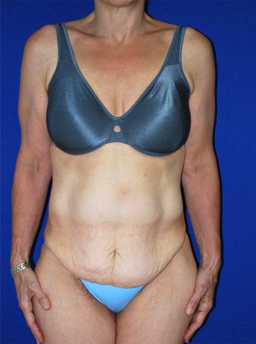 Extended Abdominoplasty Before and After | Plastic Surgery Institute of Washington