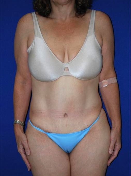 Extended Abdominoplasty Before and After | Plastic Surgery Institute of Washington
