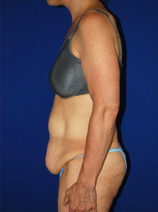 Extended Abdominoplasty Before and After | Plastic Surgery Institute of Washington