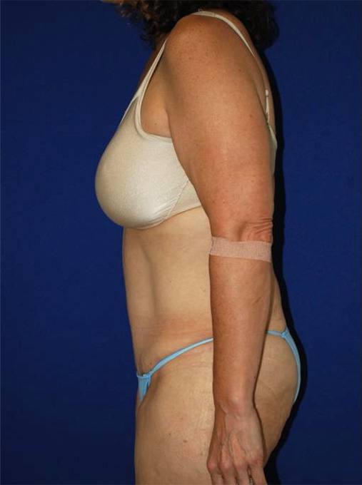 Extended Abdominoplasty Before and After | Plastic Surgery Institute of Washington