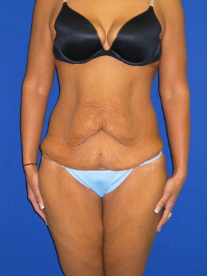 Extended Abdominoplasty Before and After | Plastic Surgery Institute of Washington