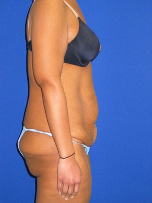 Extended Abdominoplasty Before and After | Plastic Surgery Institute of Washington