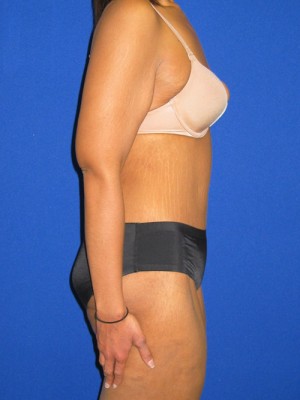 Extended Abdominoplasty Before and After | Plastic Surgery Institute of Washington