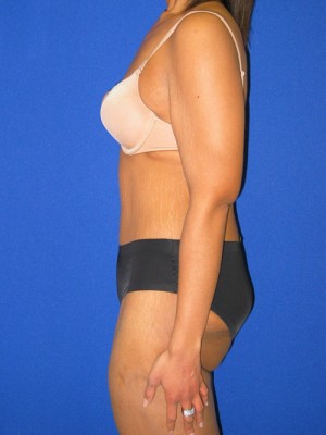 Extended Abdominoplasty Before and After | Plastic Surgery Institute of Washington